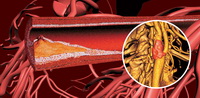 ateroskleroz